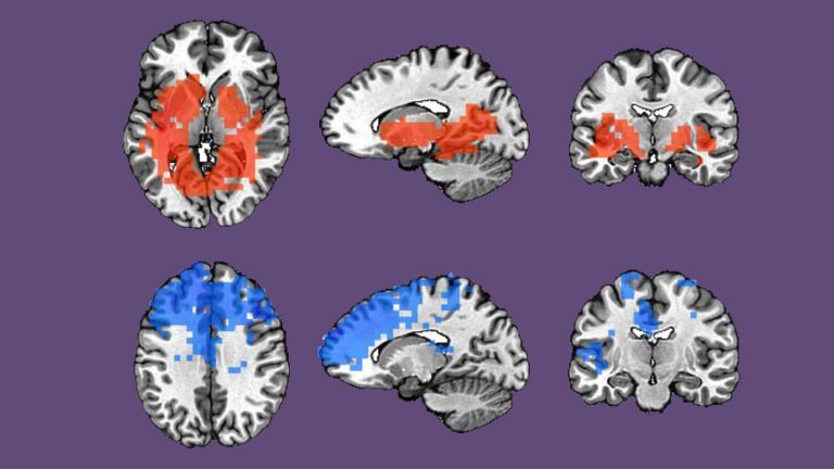 Immune signals may help predict responses to therapies for difficult-to-treat depression