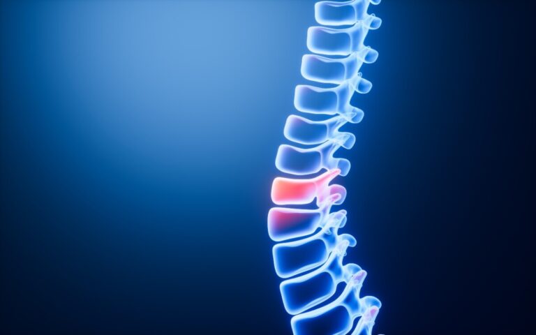 Excess Adiposity Linked to Vertebral Fracture Risk in Early Breast Cancer