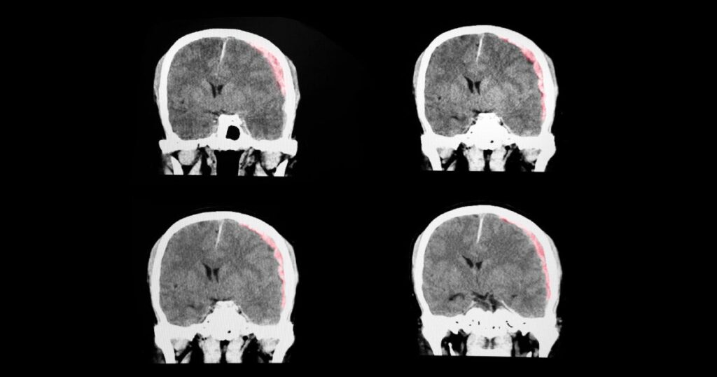 Traumatic Brain Injury Mental Health Symptoms in Older Adults