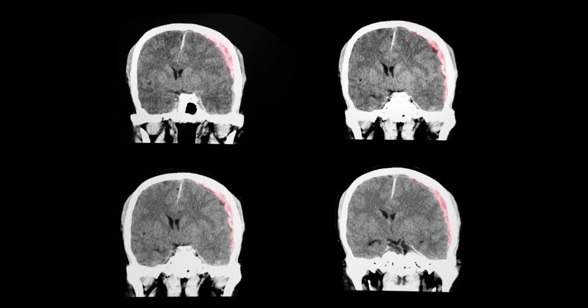 Traumatic Brain Injury Mental Health Symptoms in Older Adults
