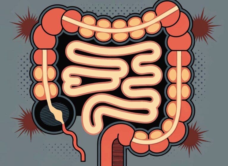What Doctors Recommend as Early-Onset Colorectal Cancer Rises