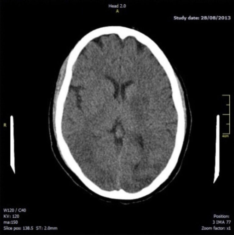 Posterior Reversible Encephalopathy Syndrome in a Postpartum Patient With Eclampsia