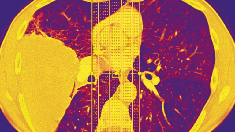 This Rare Gene Drastically Raises Lung Cancer Risk in People Who Never Smoked