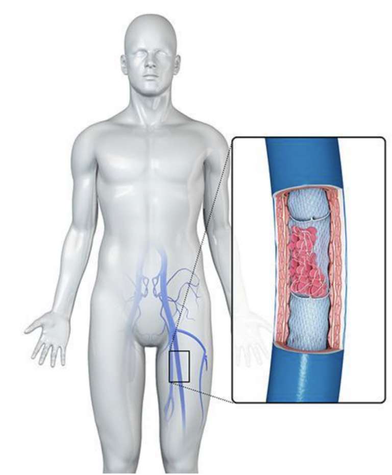 Understanding Iliofemoral Deep Vein Thrombosis and Phlegmasia Cerulea Dolens