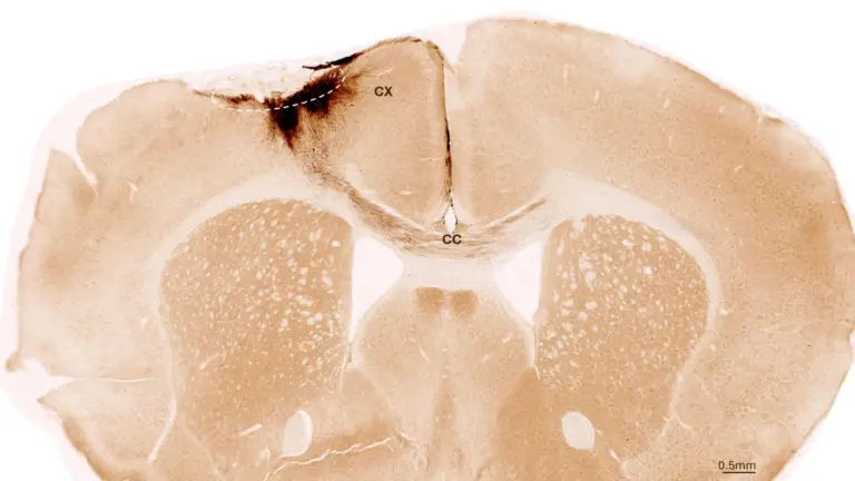 Stem cells reverse stroke damage and restore movement in mice