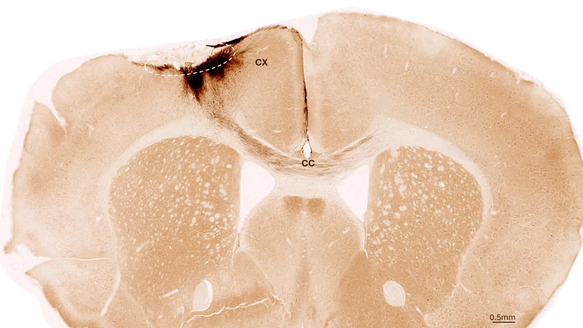 Stem cells reverse stroke damage and restore movement in mice