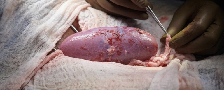 Pig kidneys successfully transplanted into humans