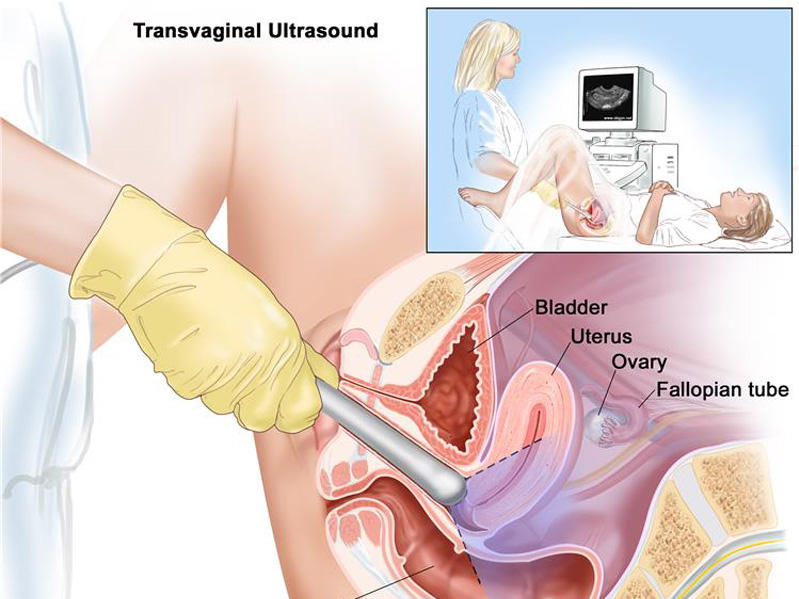 UK doctors develop non-invasive test for womb cancer in women bleeding after menopause