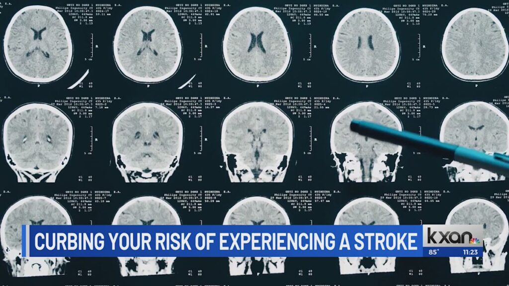 Why are more young adults having strokes now than 30 years ago